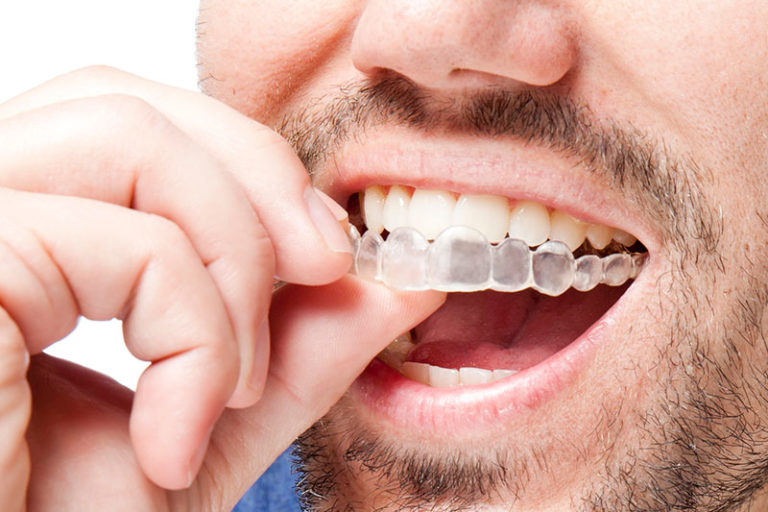 Invisalign in Garden Grove, Clear Braces Orange County Orthodontics