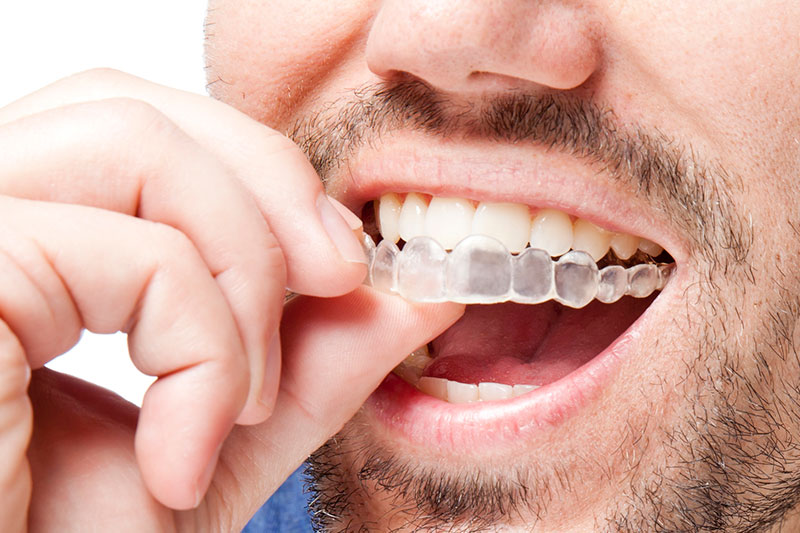 Invisalign in Garden Grove, Clear Braces | Orange County Orthodontics